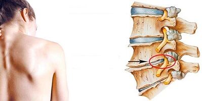 Mechanizm rozwoju osteochondrozy szyjki macicy