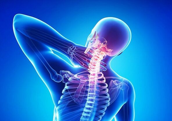 Ból w kręgosłupie szyjnym z osteochondrozą