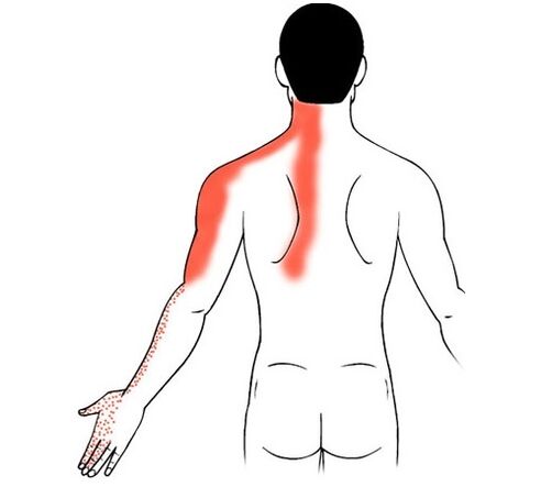 osteochondroza szyjna jako przyczyna bólu stawów palców